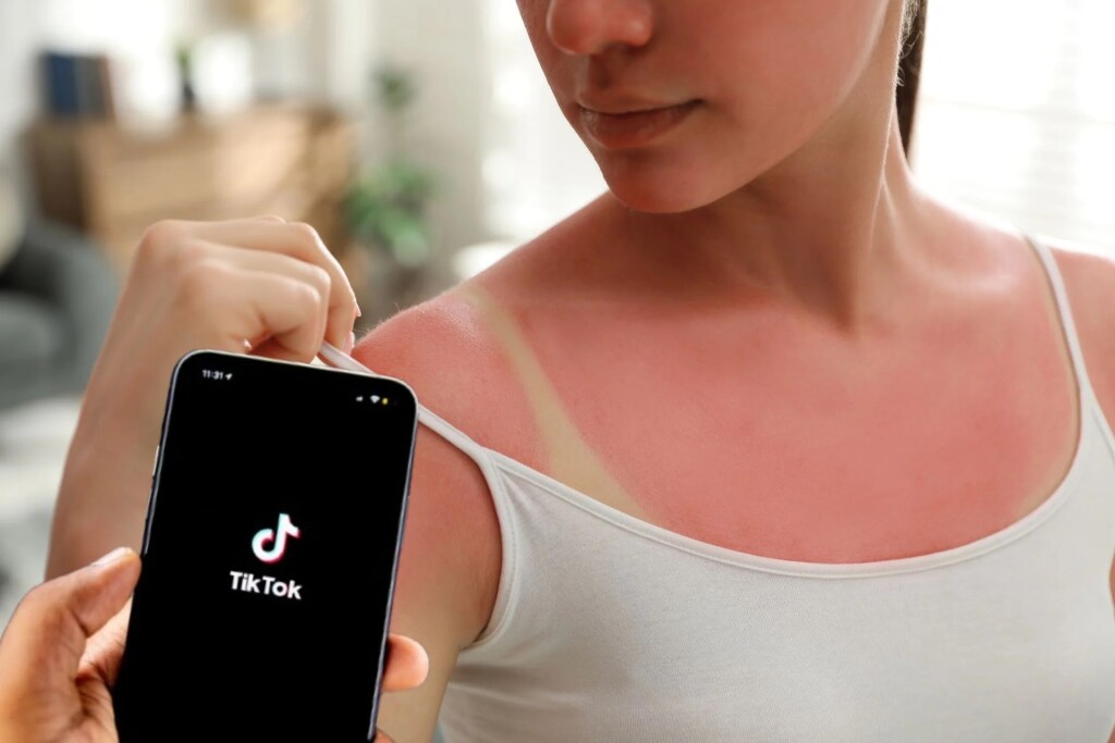“Burn lines” : c’est quoi cette tendance qui pousse les ados à mettre en danger leur peau ?