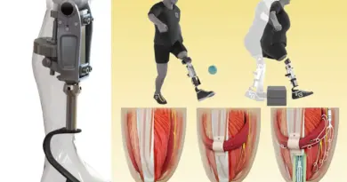 Cette prothèse est directement implantée dans l’os et greffée aux muscles