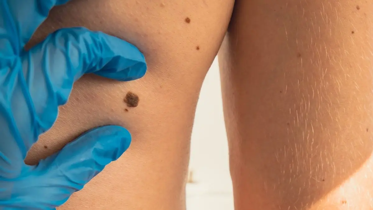 Acné, mélanome, eczéma : la télé-expertise dermatologique bouscule les parcours de soins