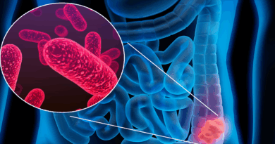 Détecter le cancer colorectal grâce aux bactéries intestinales - Médias