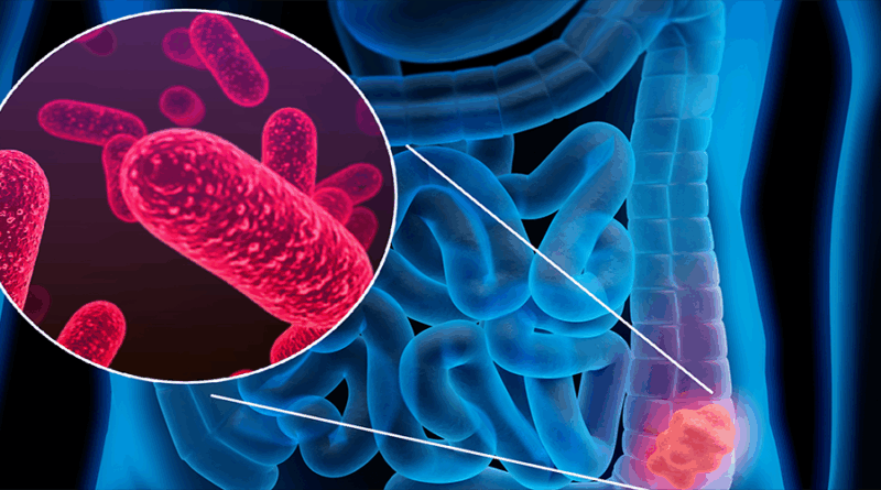 Détecter le cancer colorectal grâce aux bactéries intestinales - Médias