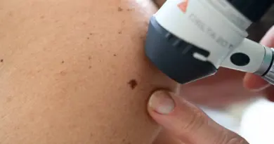 Les dermatologues à fleur de peau sur la question de leurs effectifs