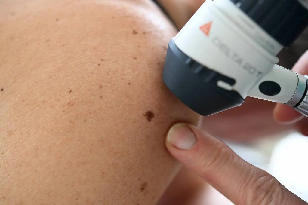 Les dermatologues à fleur de peau sur la question de leurs effectifs