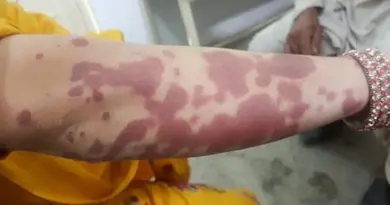 Purpura fulminans : définition, causes, photo, symptômes et traitement