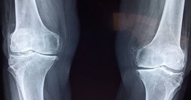 Cancer des os : les signes précoces à ne pas ignorer