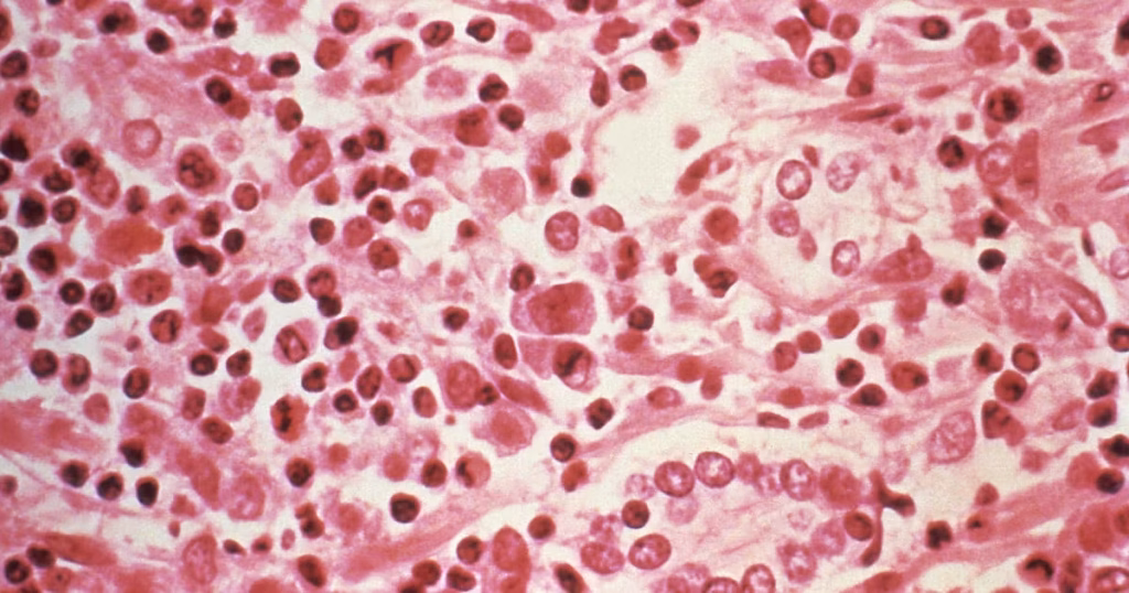 Infection à hantavirus : transmission et symptômes observés dans plusieurs régions.