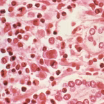 Infection à hantavirus : transmission et symptômes observés dans plusieurs régions.