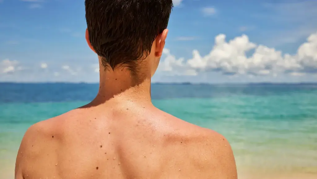 Les grains de beauté : composition et caractéristiques selon des experts dermatologues.