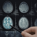 Une cartographie génétique élargie de la maladie d&rsquo;Alzheimer réalisée par des chercheurs européens.