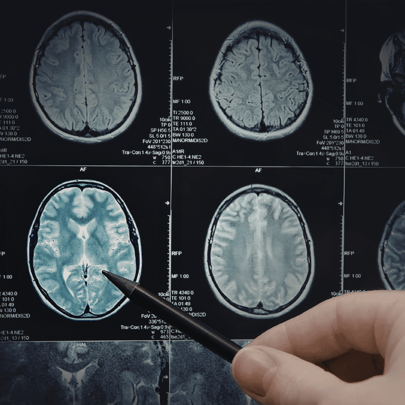 Une cartographie génétique élargie de la maladie d’Alzheimer réalisée par des chercheurs européens.