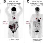 Cancer : des troubles cérébraux mystérieux observés chez certains patients en France