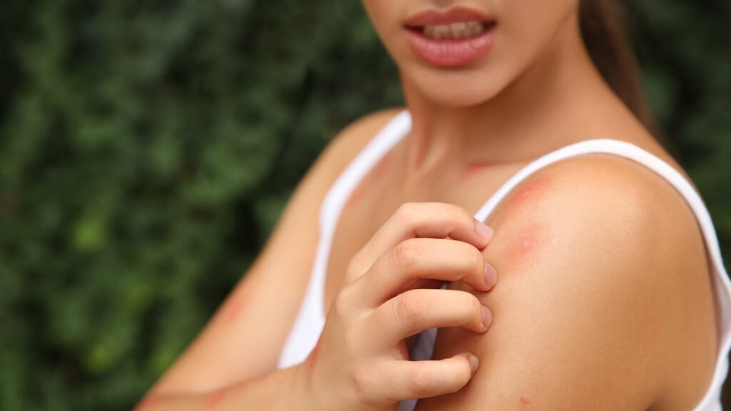 Gratter une piqûre de moustique augmente le risque d’infection, avertissent les médecins.