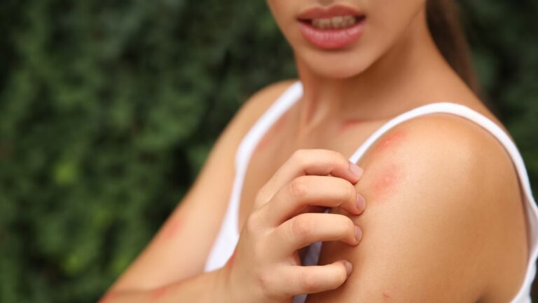Gratter une piqûre de moustique augmente le risque d’infection, avertissent les médecins.