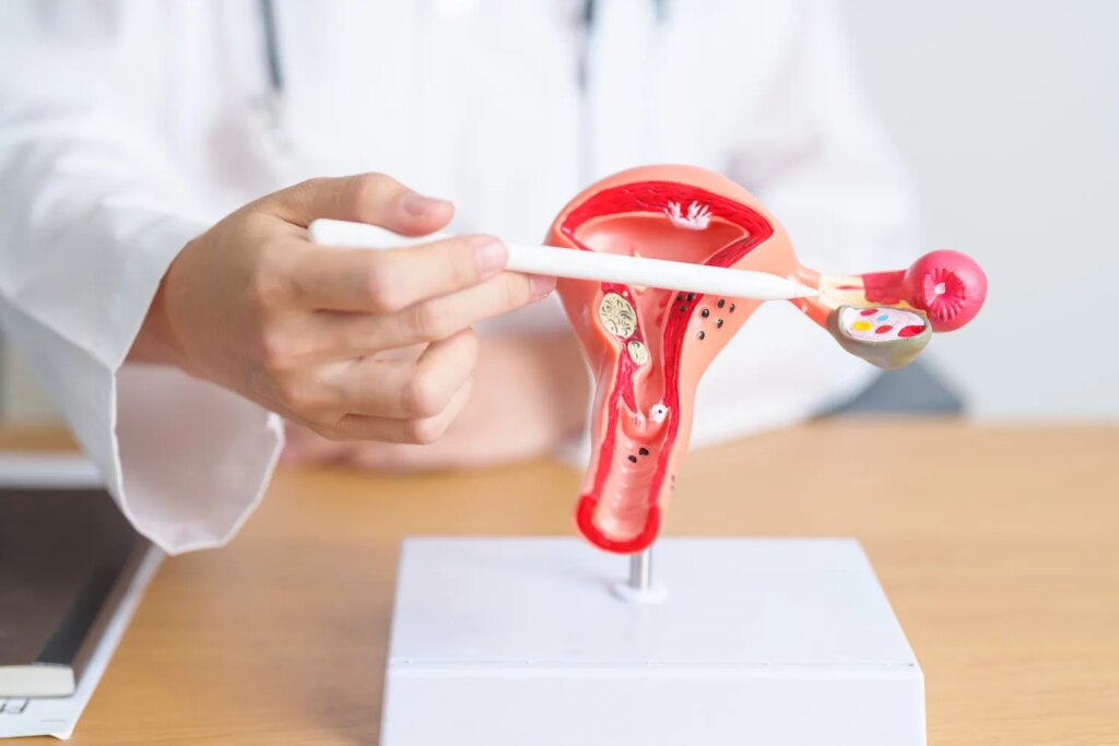 Le SOPK renommé Smop : une avancée pour le traitement de l’infertilité féminine.