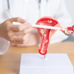 Le SOPK renommé Smop : une avancée pour le traitement de l’infertilité féminine.