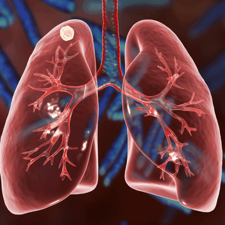 Un peptide des abysses pourrait améliorer le traitement des infections pulmonaires liées à la mucoviscidose.