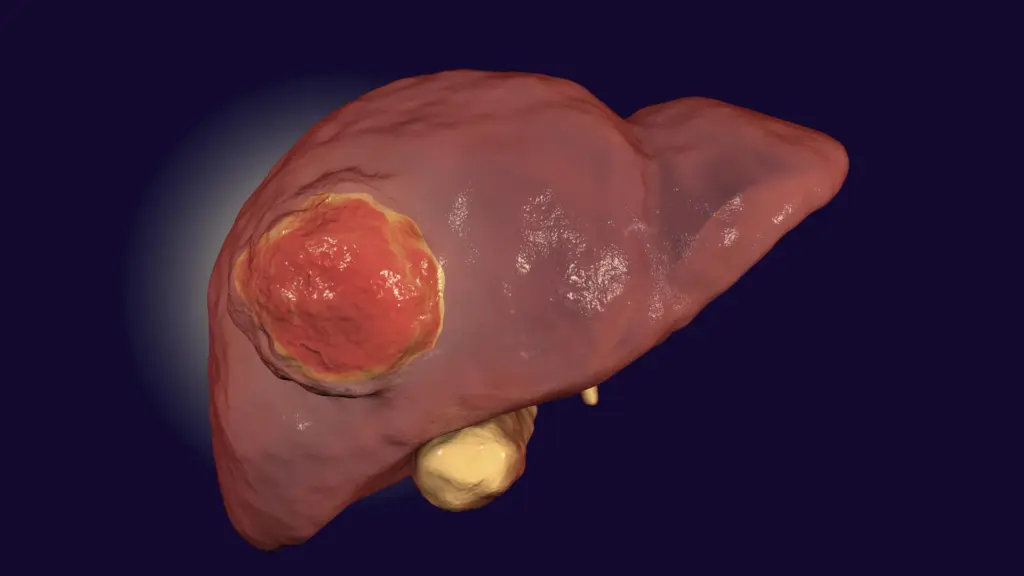Un médicament approuvé par la FDA pourrait renforcer l’immunothérapie contre un cancer du foie rare.
