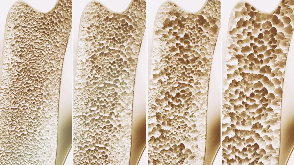 Une revue majeure indique peu de bénéfices de la prise de calcium et de vitamine D pour les os.