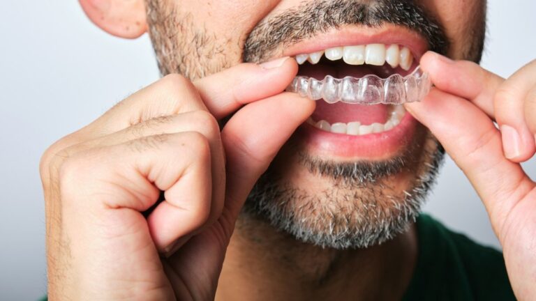 Orthodontie : maintenir l’appareil de contention est essentiel pour éviter des complications.