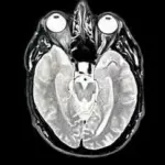 Des scientifiques japonais identifient une substance potentiellement liée à la maladie d&rsquo;Alzheimer.
