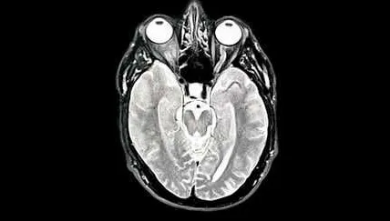 Des scientifiques japonais identifient une substance potentiellement liée à la maladie d’Alzheimer.