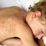 Rougeole : augmentation des cas aux États-Unis suscite des inquiétudes sanitaires.