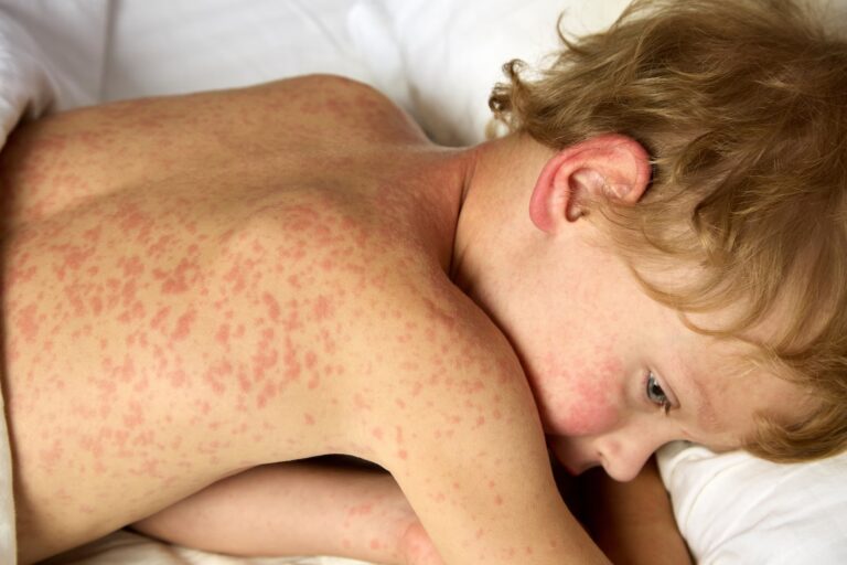 Rougeole : augmentation des cas aux États-Unis suscite des inquiétudes sanitaires.