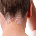 Un gène identifié ouvre la voie à des traitements personnalisés pour le psoriasis.