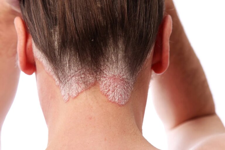 Un gène identifié ouvre la voie à des traitements personnalisés pour le psoriasis.