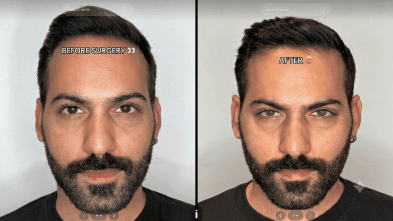 Changement de couleur des yeux : une tendance TikTok suscite des inquiétudes médicales en France.