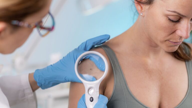 Grains de beauté suspects : conseils d’une onco-dermatologue pour les repérer en France