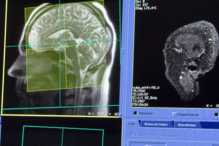 Le CHU de Nice acquiert une nouvelle IRM pour améliorer le diagnostic des pathologies cérébrales.