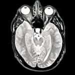 Des scientifiques japonais identifient une substance potentiellement liée à la maladie d&rsquo;Alzheimer.
