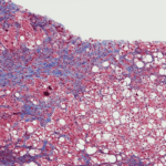 L&rsquo;horloge biologique influence la fibrose hépatique selon des chercheurs français.