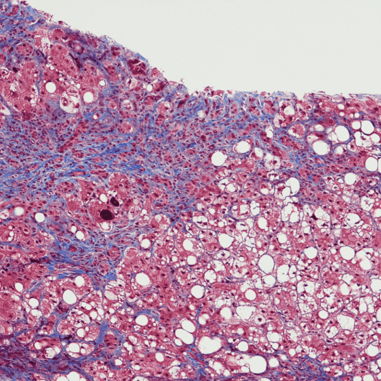 L’horloge biologique influence la fibrose hépatique selon des chercheurs français.