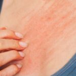 Canicule : conseils du Dr Toni Ionesco pour apaiser les démangeaisons liées aux boutons de chaleur.