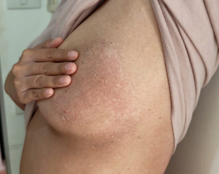 Radiodermite : symptômes, prévention et solutions recommandées par les dermatologues.