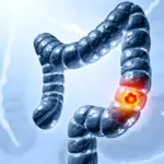Des chercheurs expliquent comment une bactérie intestinale commune déclenche le cancer du côlon.