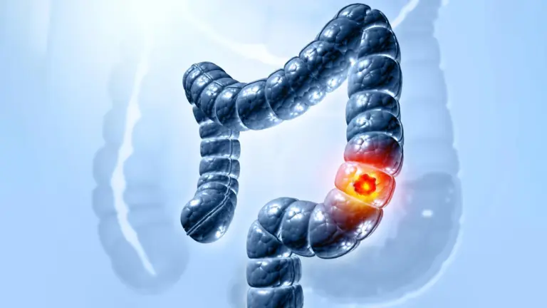 Des chercheurs expliquent comment une bactérie intestinale commune déclenche le cancer du côlon.
