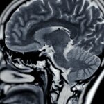 Des chercheurs japonais identifient un germe lié à la maladie d’Alzheimer.
