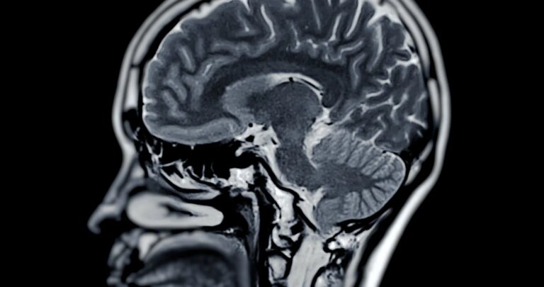 Des chercheurs japonais identifient un germe lié à la maladie d’Alzheimer.