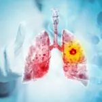 Des jeunes non-fumeurs développent un cancer du poumon : enquête sur les causes.