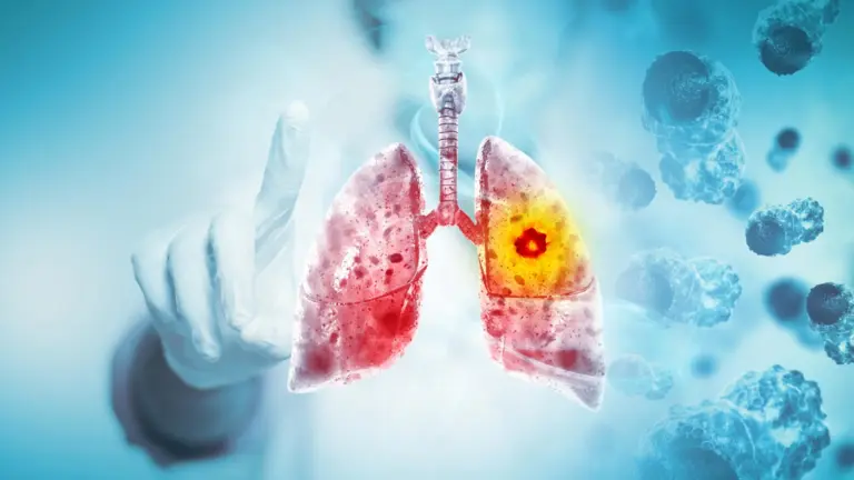 Des jeunes non-fumeurs développent un cancer du poumon : enquête sur les causes.