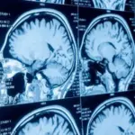 Maltraitance des personnes handicapées psychiques : études révèlent des cicatrices cérébrales.