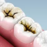 Des chercheurs découvrent une méthode simple pour prévenir les caries sans forage.