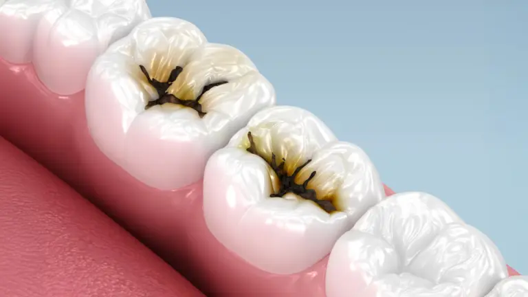 Des chercheurs découvrent une méthode simple pour prévenir les caries sans forage.