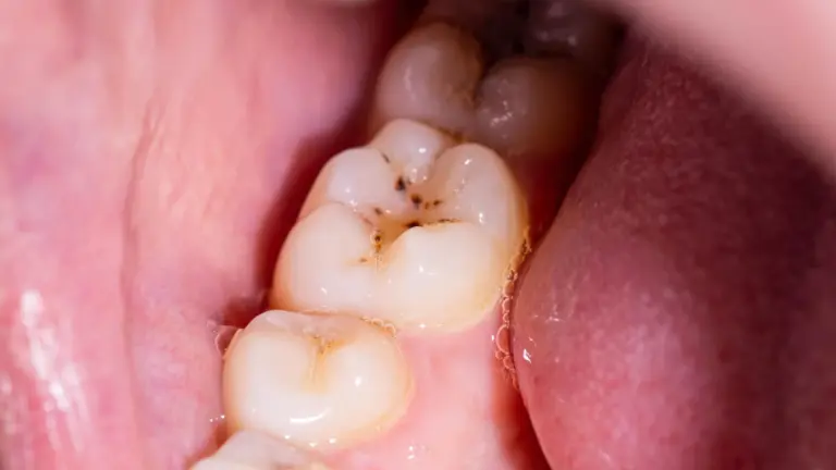 Un nouveau gel pourrait permettre la régénération de l’émail dentaire.