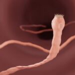 Une femme de retour d’Inde diagnostiquée avec 38 parasites dans le cerveau.