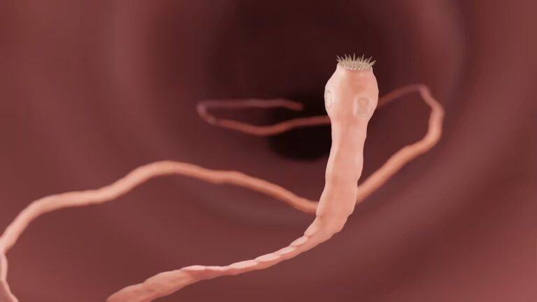 Une femme de retour d’Inde diagnostiquée avec 38 parasites dans le cerveau.