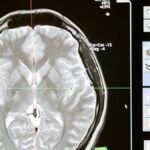 Découverte japonaise sur la « graine » liée à Alzheimer : pas de révolution dans la recherche.